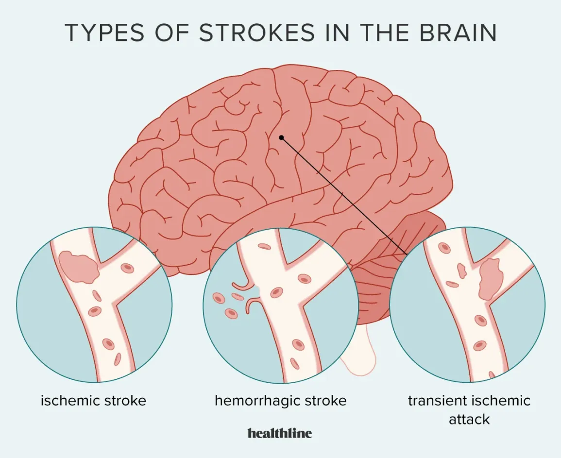 Best Brain Stroke Hospital in Raja Park
